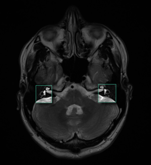 My MRI Brain scan, Mercy Neurology department